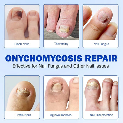 Fungal Nail Treatment Patches