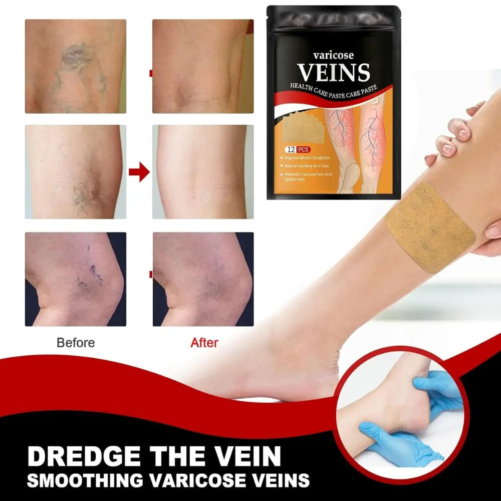 Varicose Veins Health Care Paste Pain Relief & Blood Circulation Support